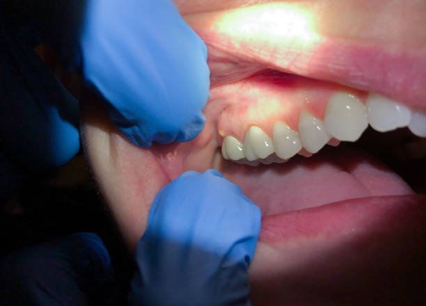 Best Emergency Dental Care for Broken or Chipped Teeth in Star Valley Ranch, WY